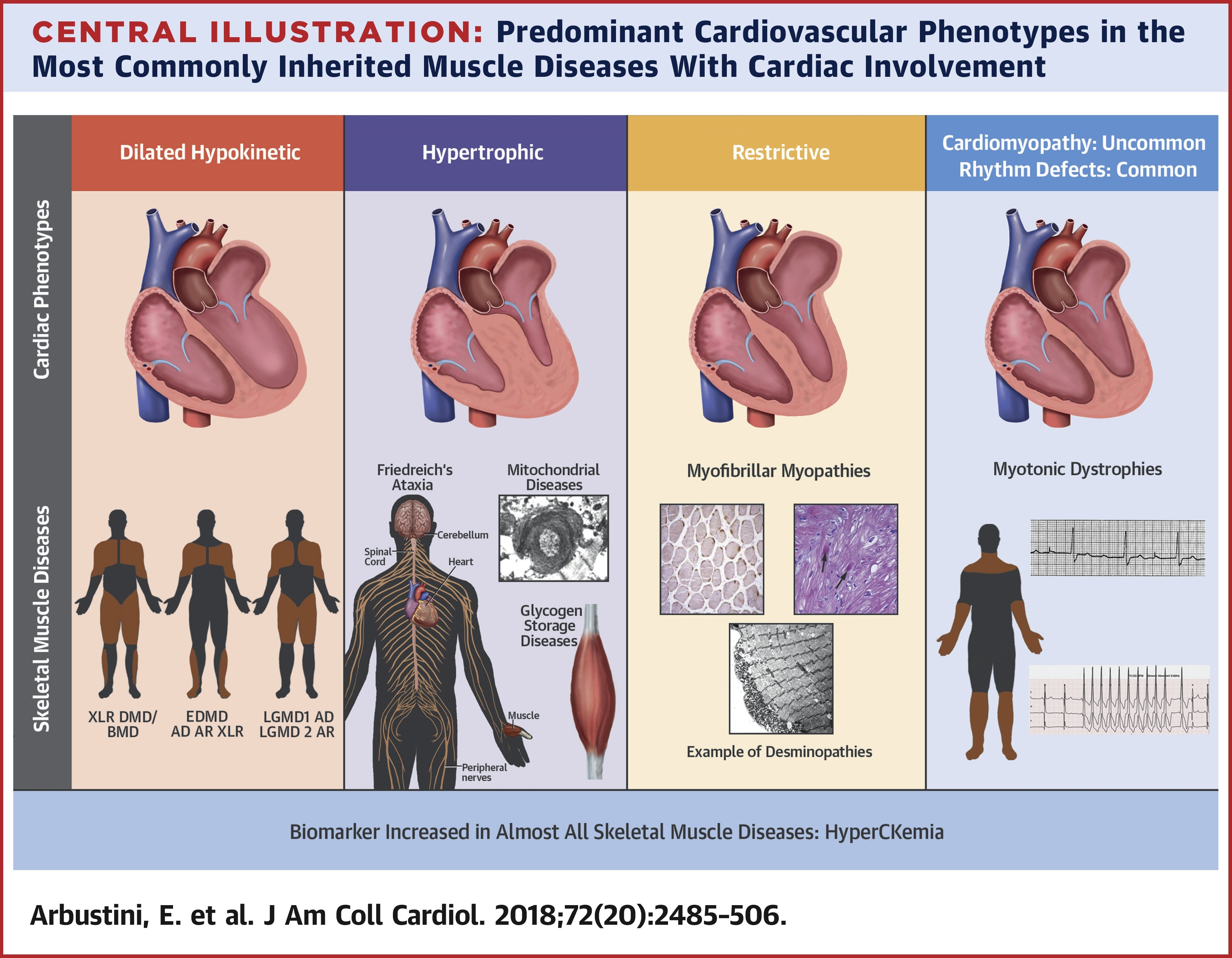 Miocardiopatías en enfermedades neuromusculares.
