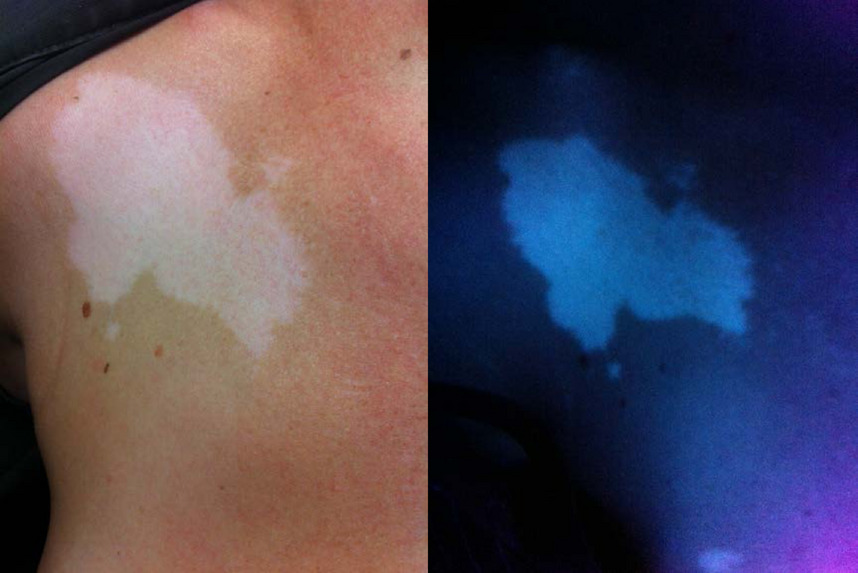 Exploración neurocutánea.