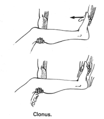Clonus aquíleo.