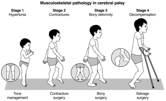 Deformidades esqueléticas en parálisis cerebral.