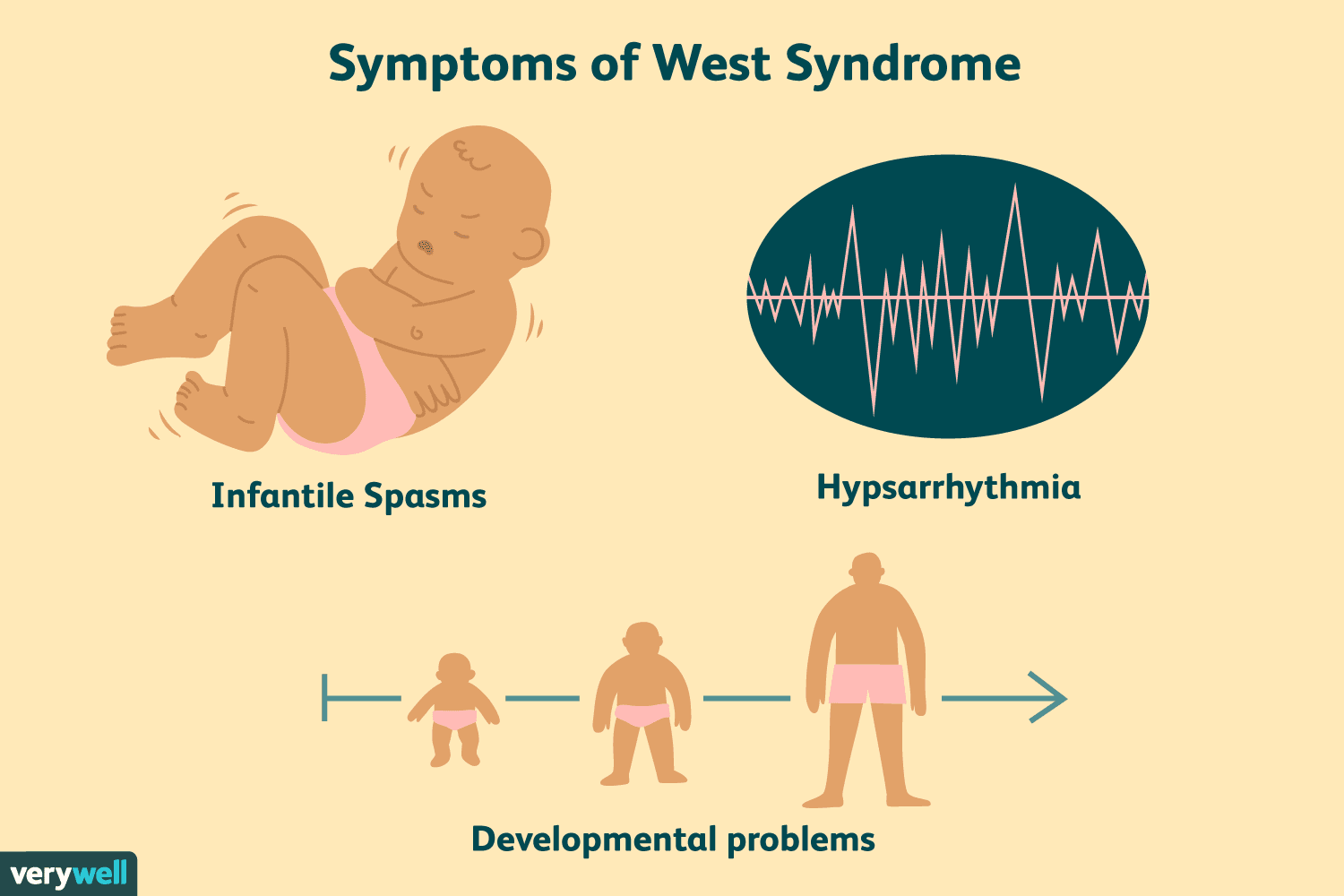 Protocolo del síndrome de West.